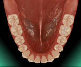 �n�C�u���b�h�Z���~�b�N�C�����[