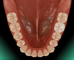 �n�C�u���b�h�Z���~�b�N�N���E��