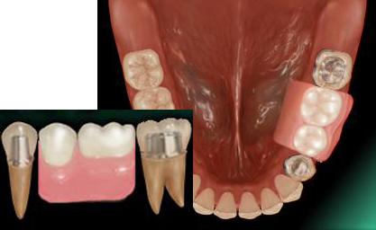 �P���`���i�R�[�k�X�j